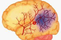 Вчені виявили механізм самовідновлення мозку після інсульту 